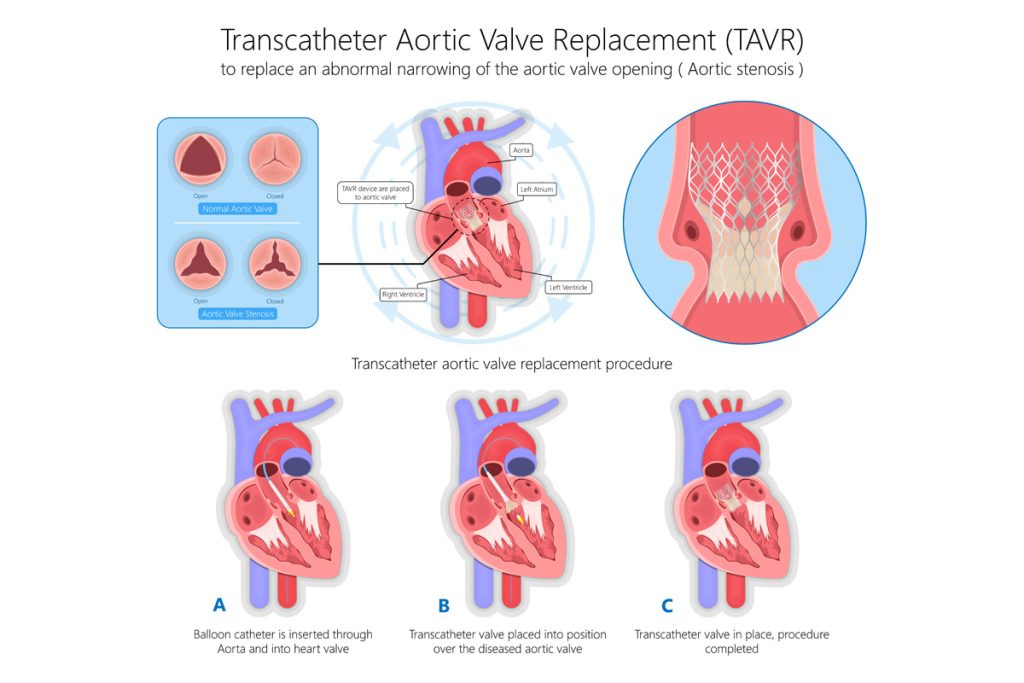החלפת מסתם אאורטלי בצנתור – שאלות ותשובות
